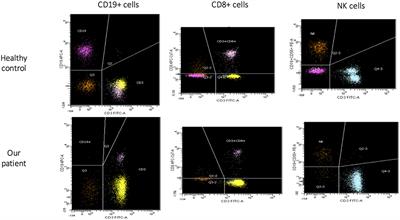 Immunological Features of Neuroblastoma Amplified Sequence Deficiency: Report of the First Case Identified Through Newborn Screening for Primary Immunodeficiency and Review of the Literature